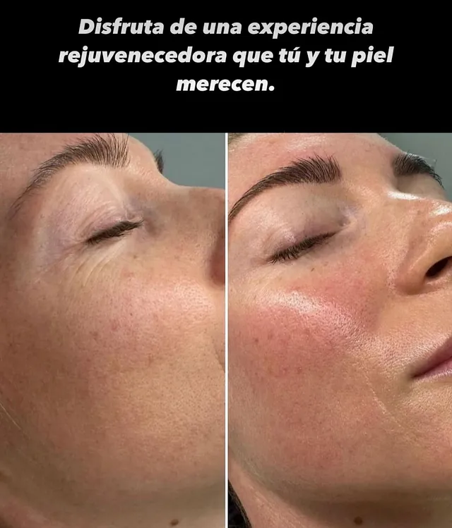 Limpieza facial